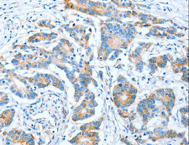 IMMT / Mitofilin Antibody - Immunohistochemistry of paraffin-embedded Human colon cancer using IMMT Polyclonal Antibody at dilution of 1:70.