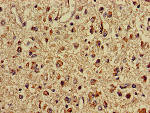 IMMT / Mitofilin Antibody - Immunohistochemistry of paraffin-embedded human glioma cancer at dilution of 1:100