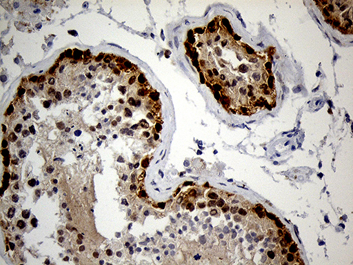 IMP-3 / IGF2BP3 Antibody - Immunohistochemical staining of paraffin-embedded Human testicle tissue within the normal limits using anti-IGF2BP3 mouse monoclonal antibody. (Heat-induced epitope retrieval by 1mM EDTA in 10mM Tris buffer. (pH8.5) at 120°C for 3 min. (1:150)