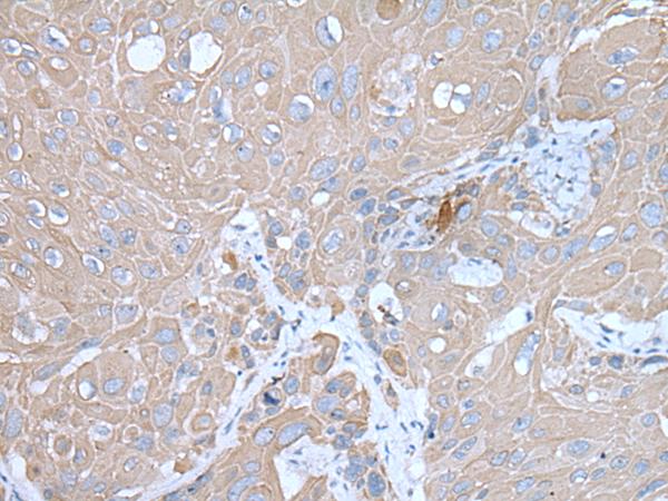 IMP-3 / IGF2BP3 Antibody - Immunohistochemistry of paraffin-embedded Human esophagus cancer tissue  using IGF2BP3 Polyclonal Antibody at dilution of 1:30(×200)