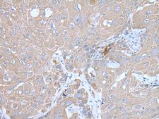 IMP-3 / IGF2BP3 Antibody - Immunohistochemistry of paraffin-embedded Human esophagus cancer tissue  using IGF2BP3 Polyclonal Antibody at dilution of 1:30(×200)