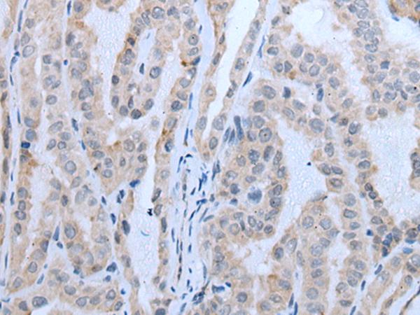 IMP-3 / IGF2BP3 Antibody - Immunohistochemistry of paraffin-embedded Human thyroid cancer tissue  using IGF2BP3 Polyclonal Antibody at dilution of 1:30(×200)