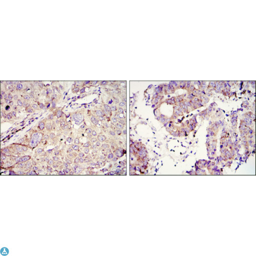 IMP3 Antibody - Immunohistochemistry (IHC) analysis of paraffin-embedded lung cancer (left) and colon tumour tissues (right) with DAB staining using IMP-3 Monoclonal Antibody.