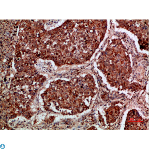 IMP3 Antibody - Immunohistochemical analysis of paraffin-embedded human-lung-cancer, antibody was diluted at 1:200.