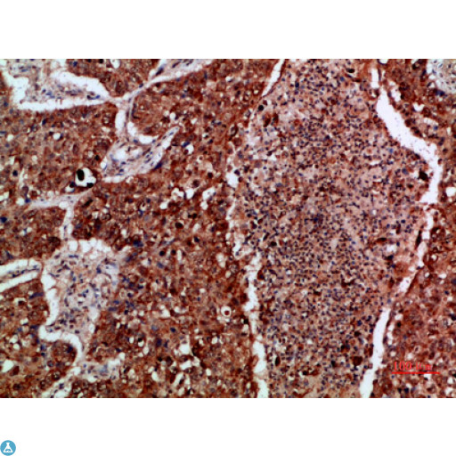 IMP3 Antibody - Immunohistochemical analysis of paraffin-embedded human-lung-cancer, antibody was diluted at 1:200.
