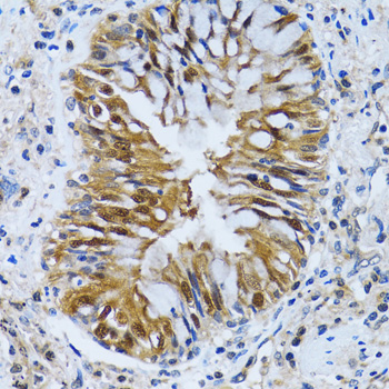 IMPA1 / IMP Antibody - Immunohistochemistry of paraffin-embedded human lung cancer tissue.