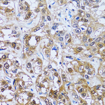 IMPA1 / IMP Antibody - Immunohistochemistry of paraffin-embedded human liver cancer tissue.