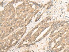 IMPA1 / IMP Antibody - Immunohistochemistry of paraffin-embedded Human liver cancer tissue  using IMPA1 Polyclonal Antibody at dilution of 1:25(×200)