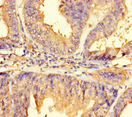 IMPACT Antibody - Immunohistochemistry of paraffin-embedded human endometrial cancer using IMPACT Antibody at dilution of 1:100