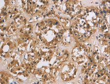 IMPDH1 Antibody - Immunohistochemistry of paraffin-embedded Human thyroid cancer using IMPDH1 Polyclonal Antibody at dilution of 1:20.