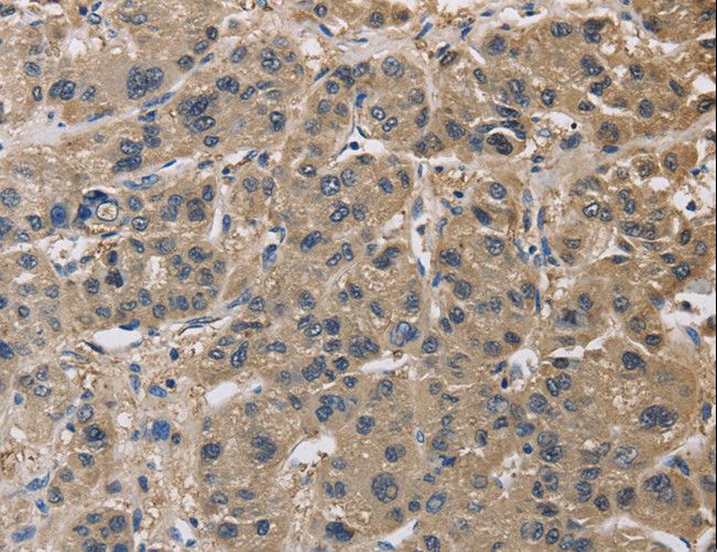 IMPDH1 Antibody - Immunohistochemistry of paraffin-embedded Human liver cancer using IMPDH1 Polyclonal Antibody at dilution of 1:20.