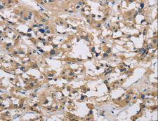 IMPDH1 Antibody - Immunohistochemistry of paraffin-embedded Human thyroid cancer using IMPDH1 Polyclonal Antibody at dilution of 1:20.