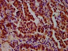 IMPDH1 Antibody - Immunohistochemistry Dilution at 1:600 and staining in paraffin-embedded human lung cancer performed on a Leica BondTM system. After dewaxing and hydration, antigen retrieval was mediated by high pressure in a citrate buffer (pH 6.0). Section was blocked with 10% normal Goat serum 30min at RT. Then primary antibody (1% BSA) was incubated at 4°C overnight. The primary is detected by a biotinylated Secondary antibody and visualized using an HRP conjugated SP system.