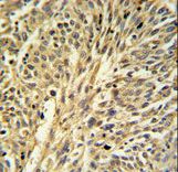 IMPDH2 Antibody - IMPDH2 Antibody IHC of formalin-fixed and paraffin-embedded human Lung carcinoma followed by peroxidase-conjugated secondary antibody and DAB staining.