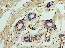 IMPDH2 Antibody - Immunohistochemistry of paraffin-embedded human breast cancer using antibody at 1:100 dilution.