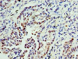 IMPDH2 Antibody - Immunohistochemistry of paraffin-embedded human lung cancer using antibody at 1:100 dilution.