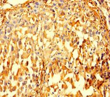 IMPDH2 Antibody - Immunohistochemistry of paraffin-embedded human lung cancer using IMPDH2 Antibody at dilution of 1:100