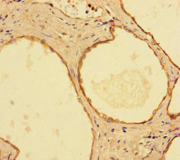 IMPDH2 Antibody - Immunohistochemistry of paraffin-embedded human prostate cancer using IMPDH2 Antibody at dilution of 1:100
