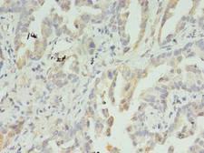 IMPDH2 Antibody - Immunohistochemistry of paraffin-embedded human lung cancer using antibody at dilution of 1:100.