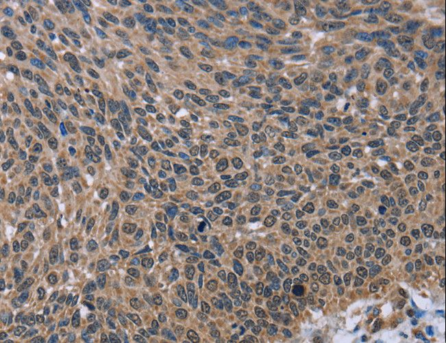 IMPDH2 Antibody - Immunohistochemistry of paraffin-embedded Human lung cancer using IMPDH2 Polyclonal Antibody at dilution of 1:60.