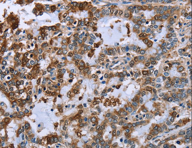 IMPDH2 Antibody - Immunohistochemistry of paraffin-embedded Human liver cancer using IMPDH2 Polyclonal Antibody at dilution of 1:60.