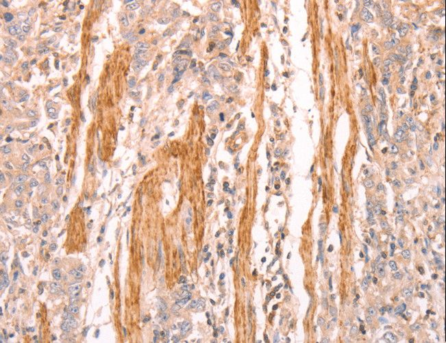 INA / Alpha Internexin Antibody - Immunohistochemistry of paraffin-embedded Human gastric cancer using INA Polyclonal Antibody at dilution of 1:25.