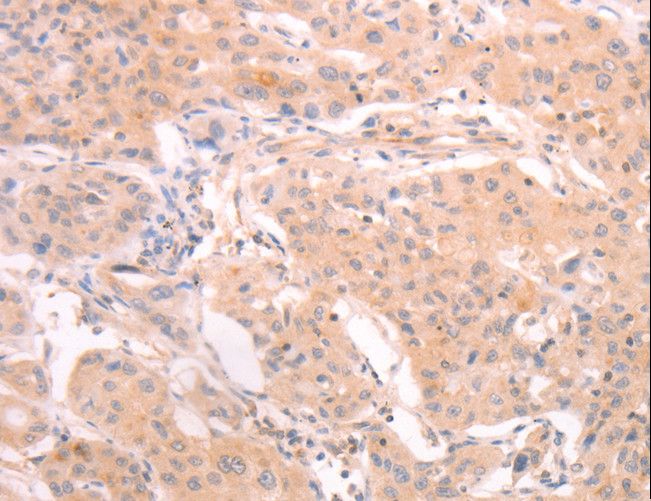INA / Alpha Internexin Antibody - Immunohistochemistry of paraffin-embedded Human lung cancer using INA Polyclonal Antibody at dilution of 1:25.