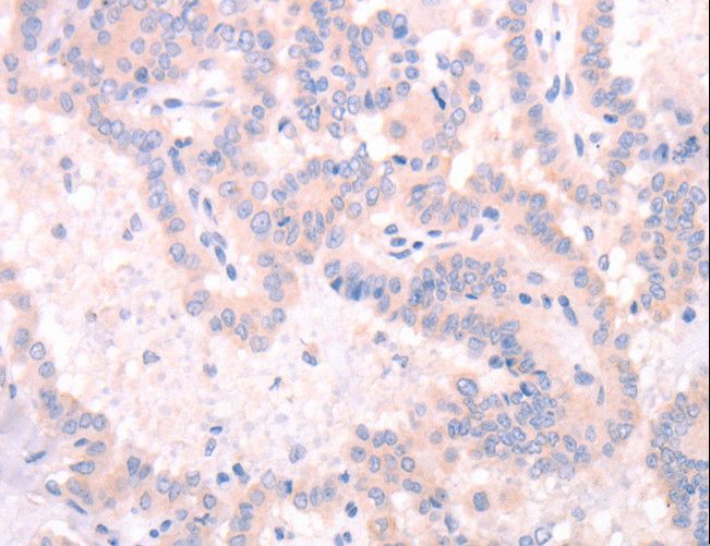 INA / Alpha Internexin Antibody - Immunohistochemistry of paraffin-embedded Human thyroid cancer using INA Polyclonal Antibody at dilution of 1:25.