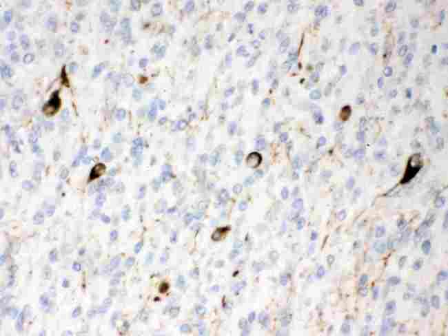 INA / Alpha Internexin Antibody - Alpha Internexin was detected in paraffin-embedded sections of human glioma tissues using rabbit anti- Alpha Internexin Antigen Affinity purified polyclonal antibody