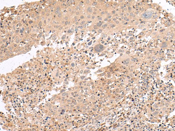 INADL / PATJ Antibody - Immunohistochemistry of paraffin-embedded Human cervical cancer tissue  using PATJ Polyclonal Antibody at dilution of 1:45(×200)