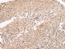 INADL / PATJ Antibody - Immunohistochemistry of paraffin-embedded Human cervical cancer tissue  using PATJ Polyclonal Antibody at dilution of 1:45(×200)