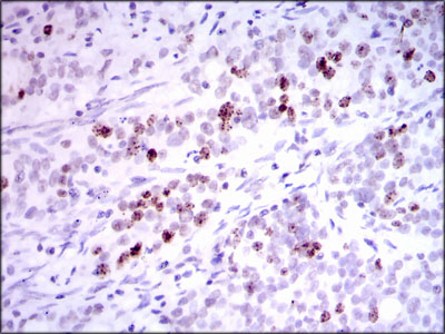 INCENP Antibody - IHC of paraffin-embedded cervical cancer tissues using INCENP mouse monoclonal antibody with DAB staining.