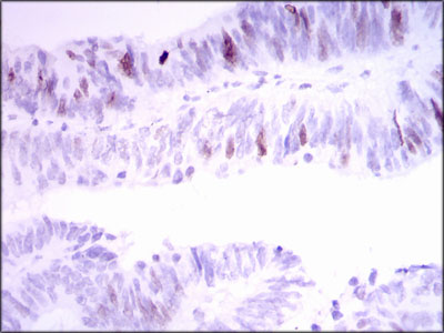 INCENP Antibody - IHC of paraffin-embedded rectum cancer tissues using INCENP mouse monoclonal antibody with DAB staining.