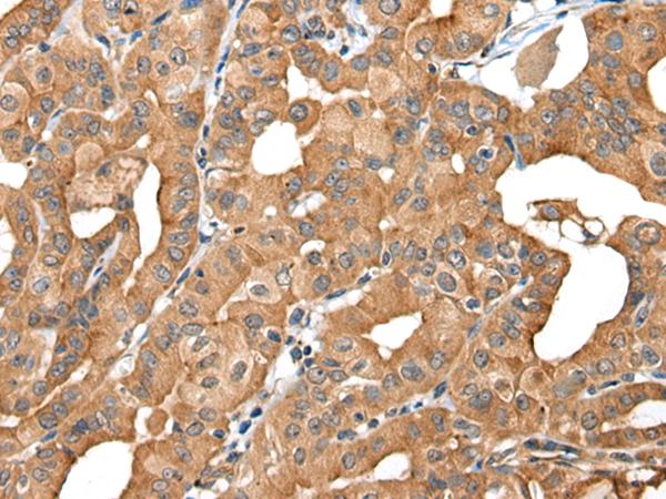 INF2 Antibody - Immunohistochemistry of paraffin-embedded Human thyroid cancer tissue  using INF2 Polyclonal Antibody at dilution of 1:40(×200)