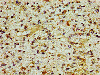 ING1 Antibody - Immunohistochemistry image of paraffin-embedded human glioma cancer at a dilution of 1:100