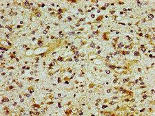 ING1 Antibody - Immunohistochemistry image of paraffin-embedded human glioma cancer at a dilution of 1:100