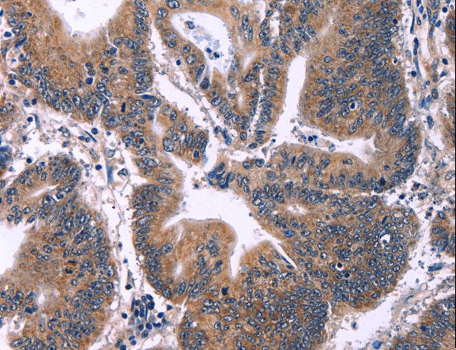 ING2 Antibody - Immunohistochemistry of paraffin-embedded Human colon cancer using ING2 Polyclonal Antibody at dilution of 1:60.