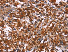 ING2 Antibody - Immunohistochemistry of paraffin-embedded Human thyroid cancer using ING2 Polyclonal Antibody at dilution of 1:40.