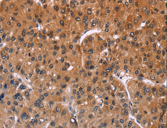 ING2 Antibody - Immunohistochemistry of paraffin-embedded Human liver cancer using ING2 Polyclonal Antibody at dilution of 1:40.