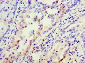 INHBA / Inhibin Beta A Antibody - Immunohistochemistry of paraffin-embedded human lung cancer using antibody at 1:100 dilution.  This image was taken for the unconjugated form of this product. Other forms have not been tested.