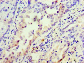 INHBA / Inhibin Beta A Antibody - Immunohistochemistry of paraffin-embedded human lung cancer at dilution 1:100