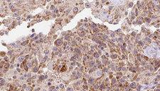 INHBA / Inhibin Beta A Antibody - 1:100 staining human Melanoma tissue by IHC-P. The sample was formaldehyde fixed and a heat mediated antigen retrieval step in citrate buffer was performed. The sample was then blocked and incubated with the antibody for 1.5 hours at 22°C. An HRP conjugated goat anti-rabbit antibody was used as the secondary.