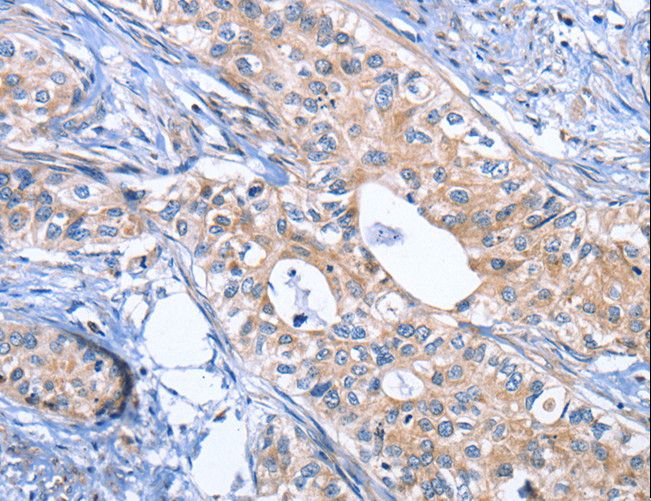 INHBC Antibody - Immunohistochemistry of paraffin-embedded Human cervical cancer using INHBC Polyclonal Antibody at dilution of 1:50.