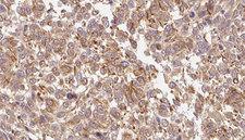 INHBC Antibody - 1:100 staining human Melanoma tissue by IHC-P. The sample was formaldehyde fixed and a heat mediated antigen retrieval step in citrate buffer was performed. The sample was then blocked and incubated with the antibody for 1.5 hours at 22°C. An HRP conjugated goat anti-rabbit antibody was used as the secondary.