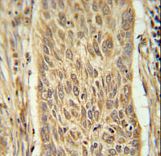INMT Antibody - INMT Antibody immunohistochemistry of formalin-fixed and paraffin-embedded human lung carcinoma followed by peroxidase-conjugated secondary antibody and DAB staining.