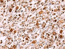 INO80 Antibody - Immunohistochemistry of paraffin-embedded Human gastric cancer tissue  using INO80 Polyclonal Antibody at dilution of 1:85(×200)