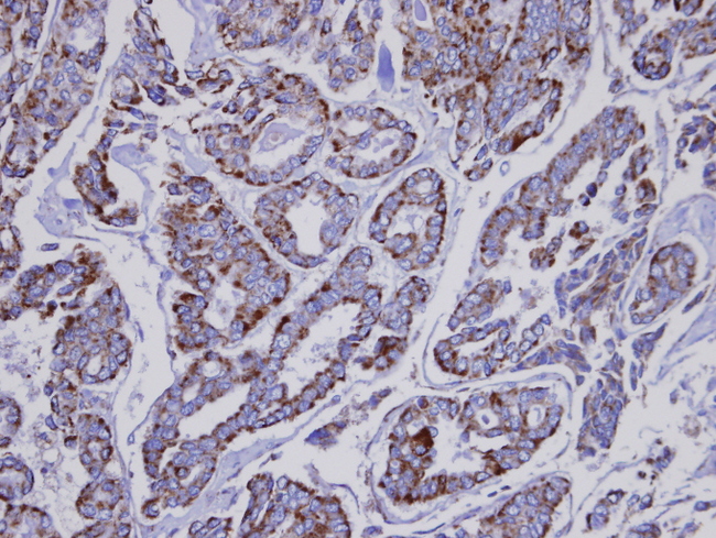 INPP1 Antibody - IHC of paraffin-embedded Thyroid gland tumor using INPP1 antibody at 1:100 dilution.