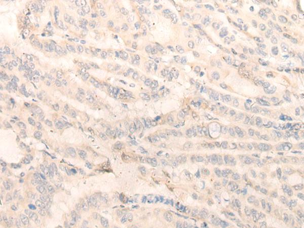 INPP1 Antibody - Immunohistochemistry of paraffin-embedded Human thyroid cancer tissue  using INPP1 Polyclonal Antibody at dilution of 1:35(×200)