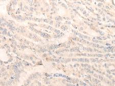 INPP1 Antibody - Immunohistochemistry of paraffin-embedded Human thyroid cancer tissue  using INPP1 Polyclonal Antibody at dilution of 1:35(×200)