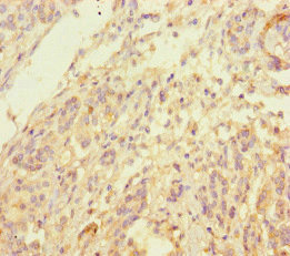 INPP4B Antibody - Immunohistochemistry of paraffin-embedded human pancreatic cancer at dilution of 1:100